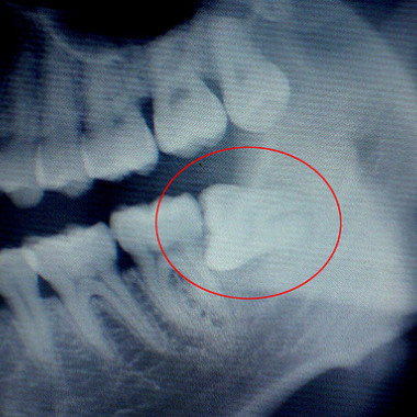 fuck the wisdom tooth